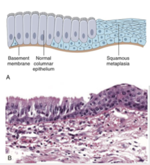 <p>What are the causes of Mataplasia? (2)</p>