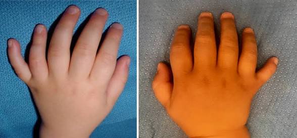 <p>Anomalía congénita caracterizada por la presencia de uno o más dedos adicionales en las manos o en los pies. </p>