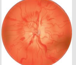 <p>elev intracranial pressure cause intraxonal edema along optic N → engorgement and swelling of optic disc<br>loss of venous pulsation; ↑disc vessels and visibility, curve over borders of disc; disc swollen w/ margins blurred; NO physiologic cup</p>