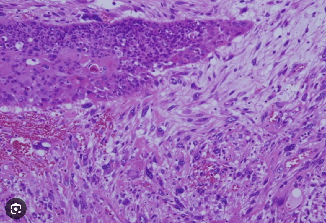 <p>Tumeur de l’oesophage </p><p>1) Diagnostic</p><p>2) Histologie</p>