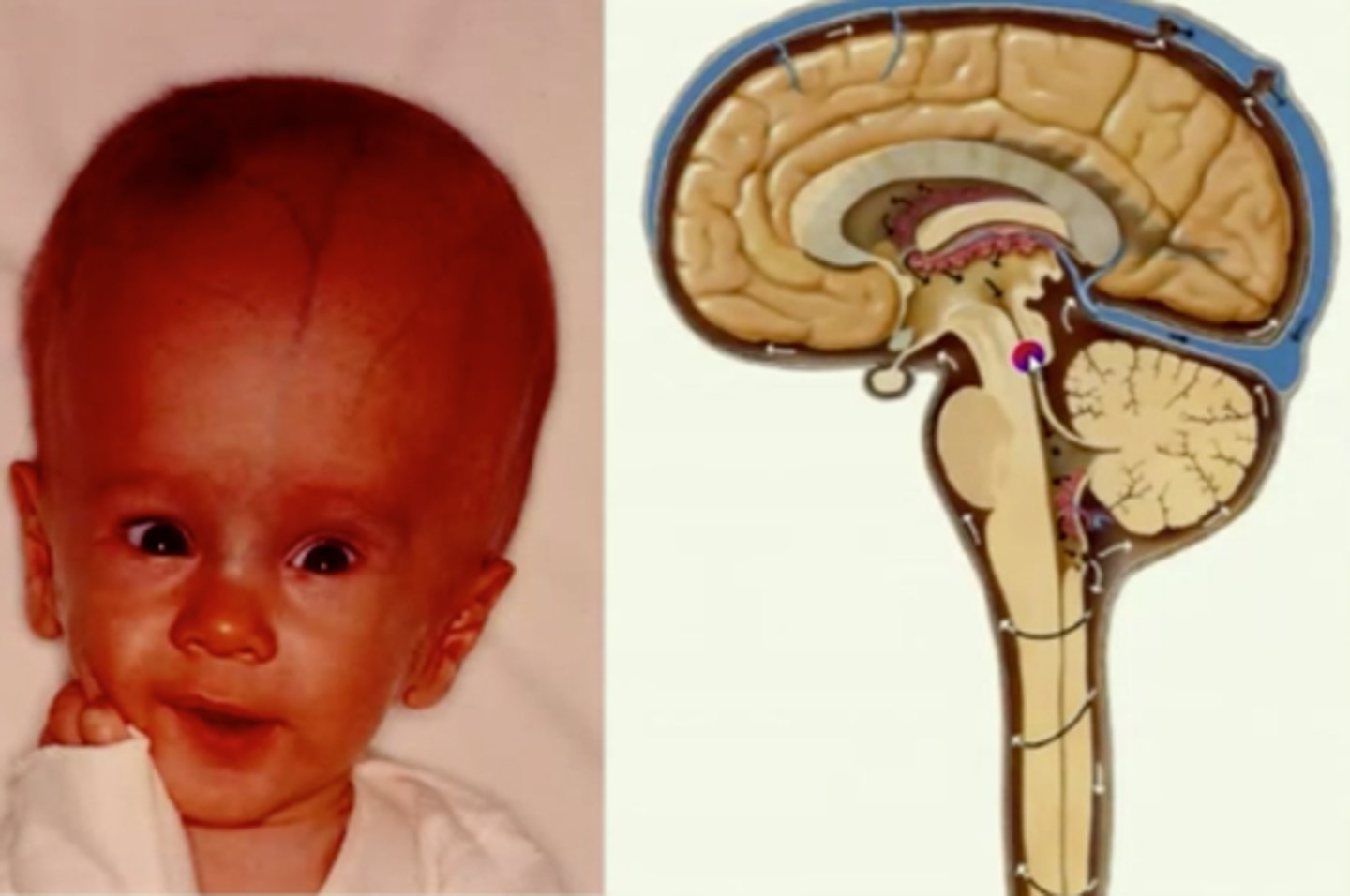 <p>excessive accumulation of cerebrospinal fluid in the ventricles of the brain</p>