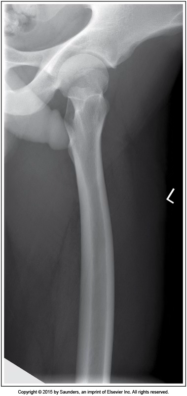 <p>lateral femur</p>