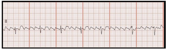 <p>Identify the above waveform:</p><p>a. Atrial flutter</p><p>b. Atrial fibrillation</p><p>c. PVC (premature vent contraction)</p><p>d. PAC (premature atrial contraction)</p>