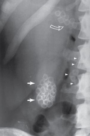 <p>Presence of one or more calculi (gallstones) in the gallbladder.</p>