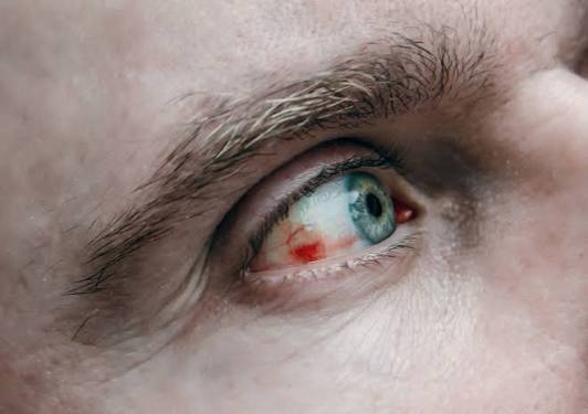 <p>Acumulación de sangre justo debajo de la conjuntiva, la membrana transparente que recubre la parte blanca del ojo. Ocurre cuando un pequeño vaso sanguíneo se rompe.</p>