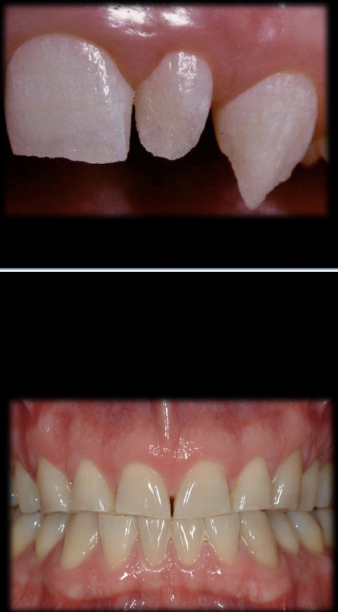 <ul><li><p>congenital malformation </p></li><li><p>fx teeth </p></li><li><p>tooth wear </p></li></ul><p></p>