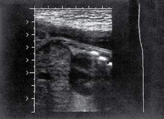 <p>Bright echogenic appearance of fetal rib cage stands out against the mid/low gray of lungs and heart muscle</p>