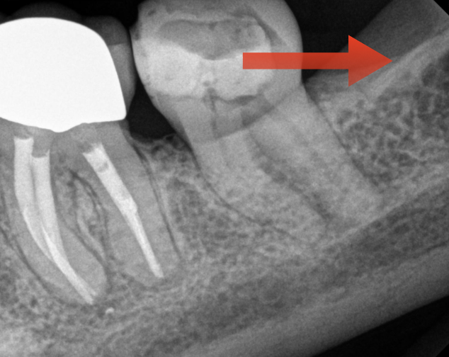 <p>What is this anatomical image you should see in a mandibular molar radiograph?</p>