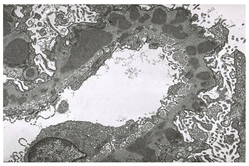 <p>A 32-year-old female is admitted to the hospital because of worsening left flank pain, fever, and new-onset shortness of breath. Two weeks before admission, she developed intermittent sharp pain in the left flank, which progressively worsened and became constant. Over the next several days, she developed nausea and multiple episodes of vomiting. One day before admission, she noted a dry cough and subjective fever. On presentation, her temperature is 39.6°C, blood pressure 102/58 mm Hg, pulse 122/min, respiratory rate 28/min, and oxygen saturation 96% on 3 L nasal cannula. Physical examination reveals diffuse crackles in both lungs and tenderness to palpation of the left lower abdomen. No rash, oral ulcers, or joint abnormalities are present. Laboratory studies show: Serum albumin: 2.8 g/dL Urinalysis: 4+ protein, 3+ blood Urine protein/creatinine ratio: 3.5 White-cell count: 19,000/µL. CT imaging reveals: Filling defects in segmental pulmonary arteries and nearly occlusive thrombus in the left renal vein and partial thrombus in the right renal vein. A renal biopsy is performed and electron microscopy microscopy findings are shown in the figure. The electron microscopy findings most strongly support which of the following mechanisms of glomerular injury?</p>