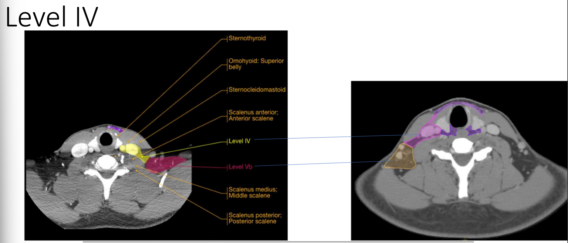 <p>what is the sup and inf border of level IVb - medial supraclavicular group</p>
