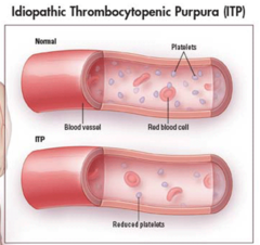 <p>Idiopathic Thrombocytopenia Purpura.</p>