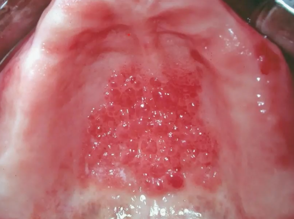 <p>55 y/o female, multiple small, red, pebbly nodules on hard palate. mild discomfort but no pain. what is the diagnosis</p>