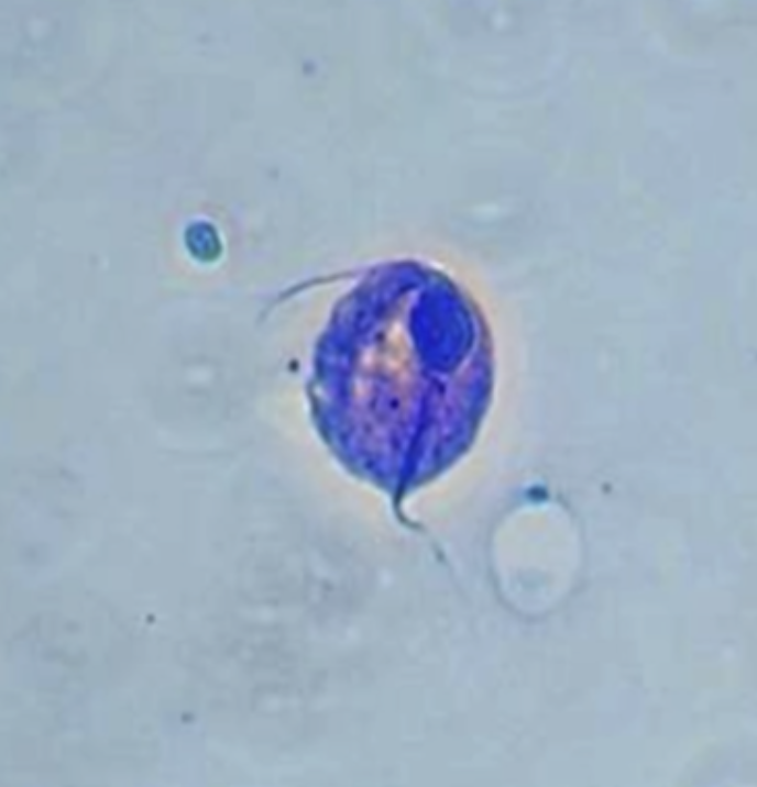<p>⚠️‼️(#7)38.This lesion is typically seen in what lower genital tract infection: A.Candidiasis B.Herpes simplex type 2 C.Bacterial vaginosis D.Trichomoniasis</p>