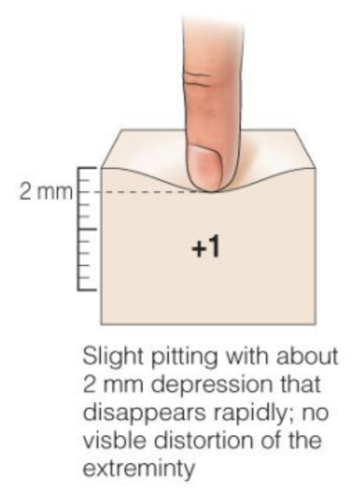 <p>2 mm</p><p>Slight pitting  that disappears rapidly </p>