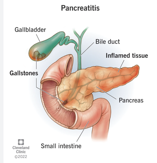 <ul><li><p>epigastric pain radiating to back</p></li><li><p>nausea/vomiting</p></li><li><p>worse after eating/alcohol</p></li></ul><p></p>