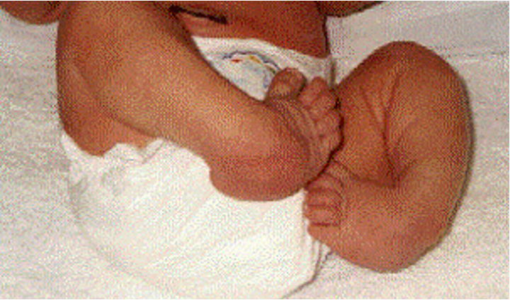 <p>talipes equinovarus </p>