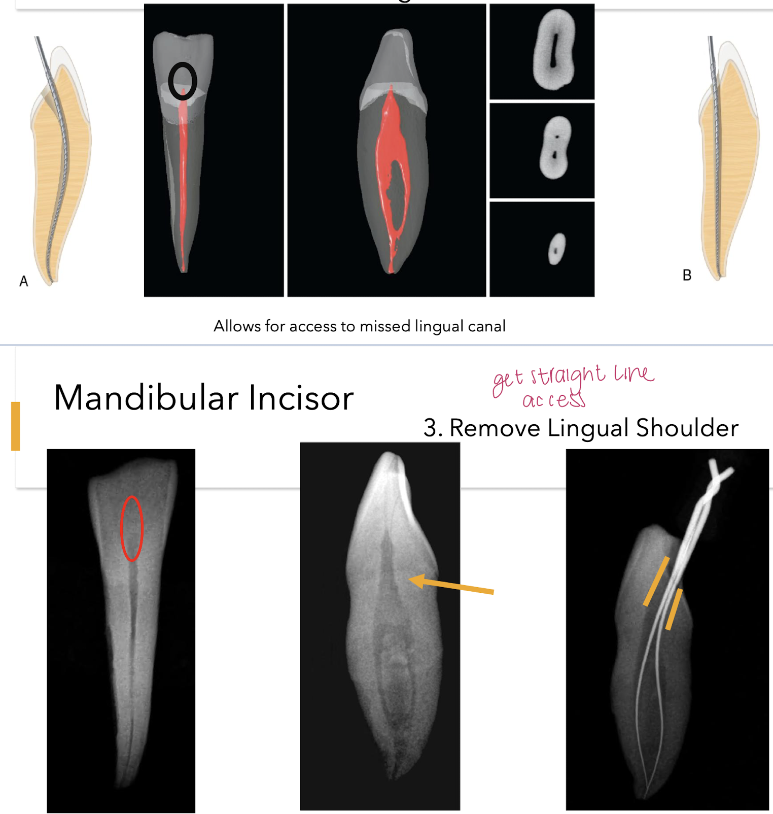 <p>gates glidden; it allows access to missed lingual canal if present </p>