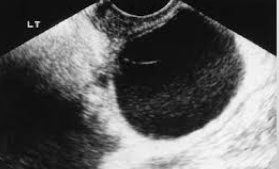 <p>pt undergone bilateral oophorectomy </p><ul><li><p>cystic mass may develop </p></li><li><p>residual tissue left behind</p></li></ul><p></p>