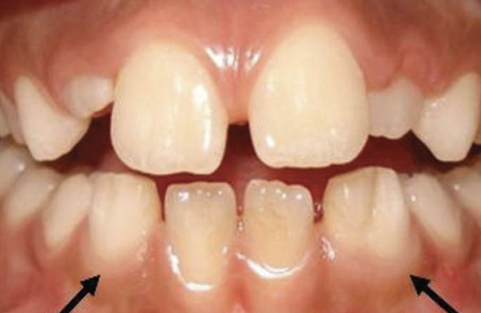 <p>defined as a single/ enlarged/ double/ joined tooth in which the tooth count reveals a MISSING tooth; two buds tried to join </p>
