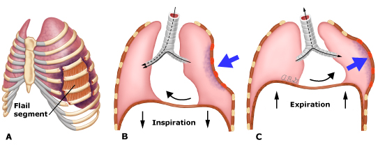 <p>multiple rib fractures→cause paradoxical movements of the thorax</p><p>inspiration→decreased intrathroacic pressure→depression of injured area</p><p>expiration→injured area bulges outward</p>