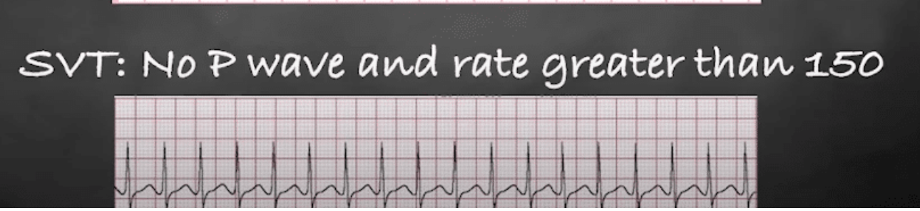 <ul><li><p>what</p><ul><li><p>sudden, rapid HR > 150 bpm</p></li><li><p>onset is random and can last minutes to hours</p></li></ul></li><li><p>symp: palpitations, dizziness, SOB, angina, fatigue</p></li><li><p>EKG: </p><ul><li><p>high rate: 150-250</p></li><li><p>regular rhythm</p></li><li><p>no visible P wave, PR not measurable</p><ul><li><p>contraction of ventricles is so strong, you don’t see the atrial contraction (which would be in P wave)</p></li></ul></li><li><p>QRS < 0.12 sec</p></li></ul></li></ul><p></p>