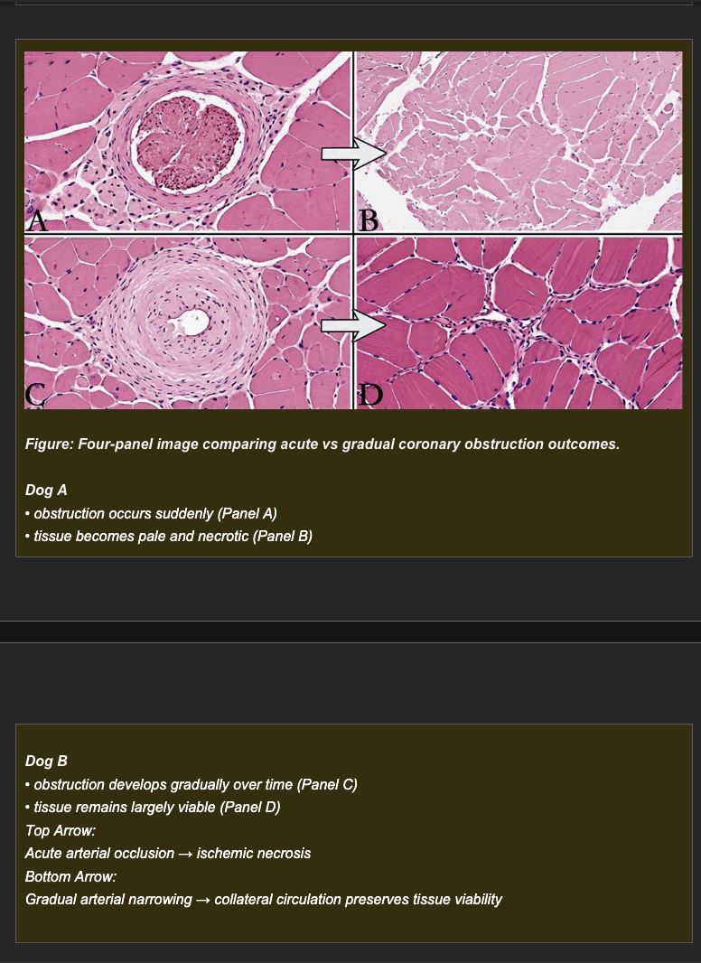 <p>Session 4A</p><p>Two dogs each develop obstruction of the left anterior descending coronary artery.</p><p>Dog A: A thrombus acutely and completely occludes the vessel. Within 30 minutes, the myocardium supplied by the vessel is pale and begins to show histologic evidence of necrosis.</p><p>Dog B: Progressive stenosis from vascular disease narrows the same vessel over 6 weeks, reaching near-complete obstruction by week 6. At week 6, despite equivalent luminal narrowing, the myocardium supplied by the vessel is viable and shows only mild histologic changes.</p><p><strong>Which mechanism best explains why Dog B's myocardium remains viable despite equivalent vascular narrowing?</strong></p><p>a. Dog B's myocardium has a lower metabolic rate than Dog A's, requiring less oxygen and therefore tolerating the obstruction better</p><p>b. Dog B's vascular disease caused fibrous replacement of myocardium that is less metabolically active and less vulnerable to ischemia</p><p>c. Dog B received anti-coagulant treatment that prevented thrombus formation over the narrowed area</p><p>d. Gradual progression of obstruction in Dog B provided time for collateral vessels to develop and grow, supplying alternative perfusion routes to the at-risk myocardium despite near-complete primary vessel obstruction</p>