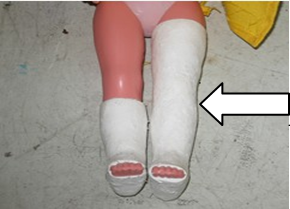 <p><span>tibia and fibula affection</span></p>