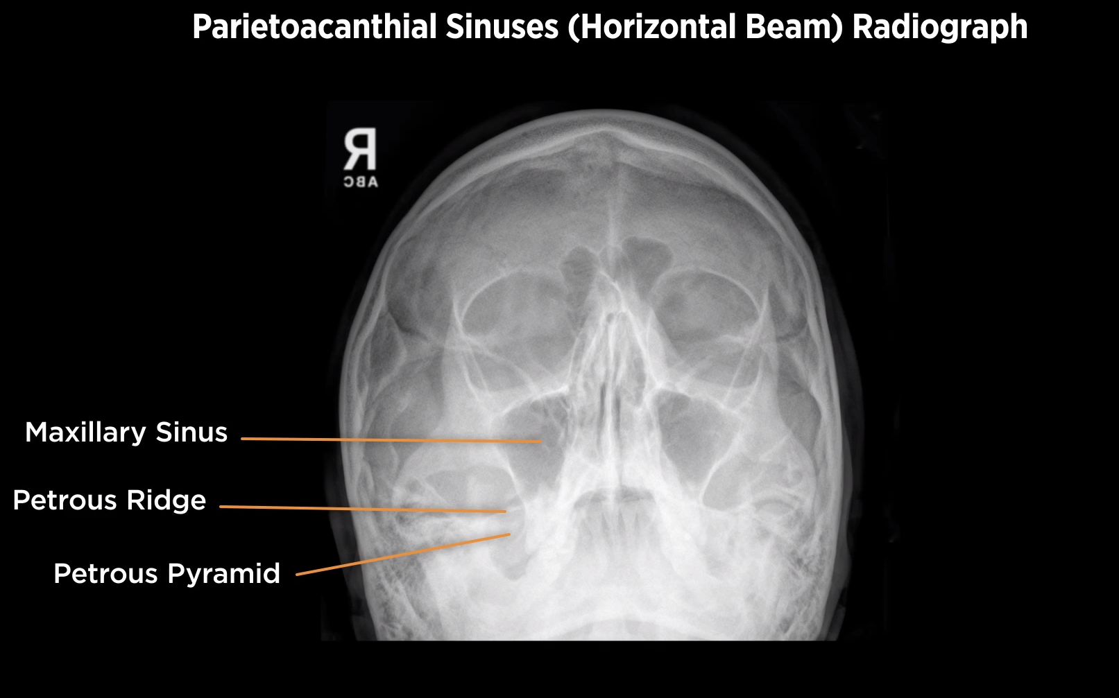 <p>Nasal Parietoacanthial view (waters)</p>