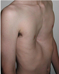 <p>Posterior depression of sternum & costal cartilages</p>