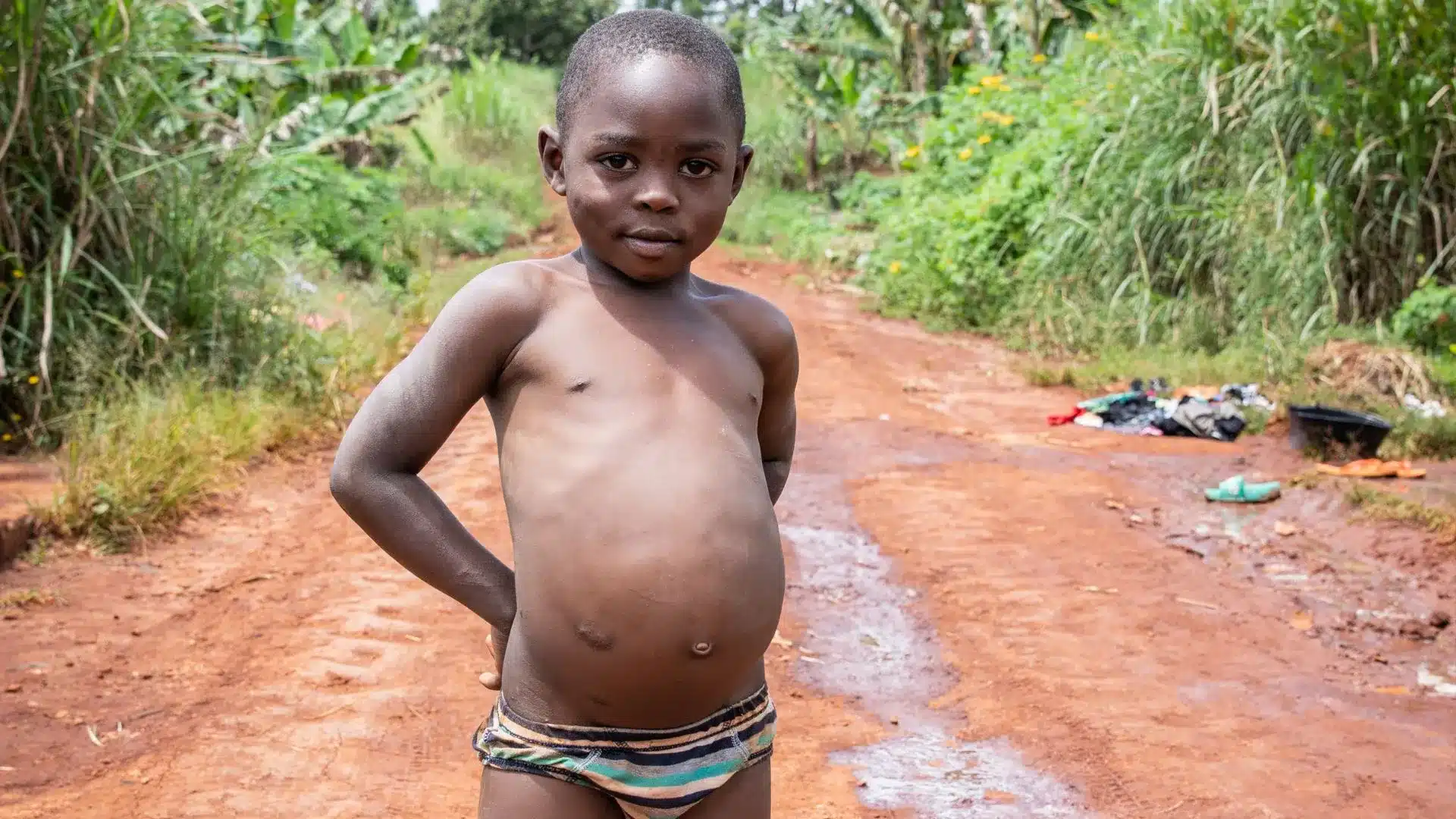 <p>Identify:</p><p>a. Marasmus</p><p>b. Kwashiorkor </p>