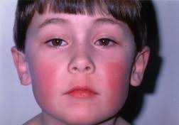 <p>what precautions are listed for <strong>fifth disease</strong>? *</p>