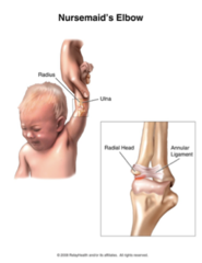 <p>subluxation of the radial head</p>