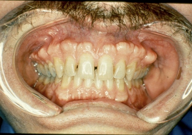 <p><span><span>the incisal edge of the maxillary anterior teeth falls in the middle third of the mandibular anterior teeth</span></span></p><p><span><span>How would you classify this overbite? </span></span></p>