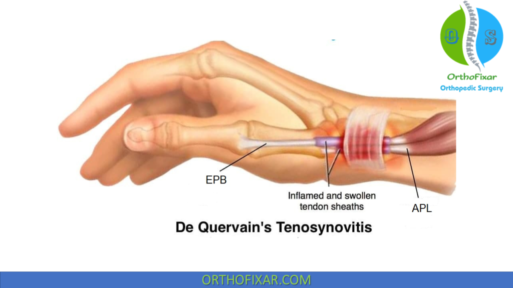 <p>Progressive tenosynovitis of 1st compartment (APL and EPB) tendon sheaths. The extensor retinaculum is thickened and there is stenosis in the canal. </p><p>MOI: caused by overuse of thumb or RD/UD and OA</p><p>Symptoms: dull ache over the radial wrist and pain with turning doorknob/keys. “Creak” with AROM.</p>