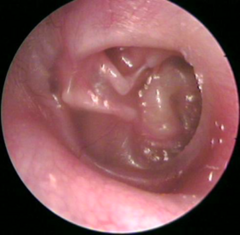 <p>Tympanic Membrane Retraction</p>