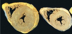 <p>A cross section of hearts common seen in our dissections. Compare to the left normal heart, name the pathologic process results in the thickening of the left ventricle wall.</p>