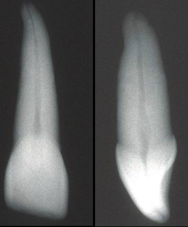 <p>Which tooth has 1 canal?</p>