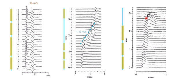 <p>leads to degeneration of myelin, which results in exposed axons. </p><ul><li><p>When axons are exposed for too long, they can start degenerating as well. </p></li><li><p>Demyelination slows or blocks action potential propagation.</p></li></ul><p></p>