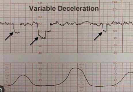 <p><span style="line-height: 23.1667px;"><u><span>Unpredictable, abrupt drops</span></u></span><span style="line-height: 20.85px;"><span>. May indicate cord compression. Tends to happen after rupture of membranes.</span></span></p><p><span style="line-height: 20.85px;"><span>Nurse action: </span></span><span style="line-height: 23.1667px;"><mark data-color="purple" style="background-color: purple; color: inherit;"><span>change PT position to lying on lateral. </span></mark></span><span style="line-height: 20.85px;"><mark data-color="purple" style="background-color: purple; color: inherit;"><span>If cord prolapse: </span></mark></span><span style="line-height: 23.1667px;"><mark data-color="purple" style="background-color: purple; color: inherit;"><span>O2 and knees to chest position</span></mark></span></p>