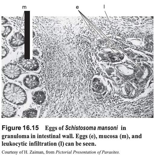 <p>Schistosoma mansoni, eggs, in intestine. (Phylum Platyhelminthes, Subphylum Neodermata, Class Trematoda, Subclass Digenea, Family Schistosomatidae). Note the granulomas filled with eggs.</p>