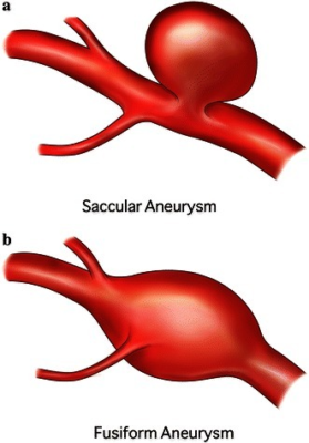 <p>Define an aneurysm</p>