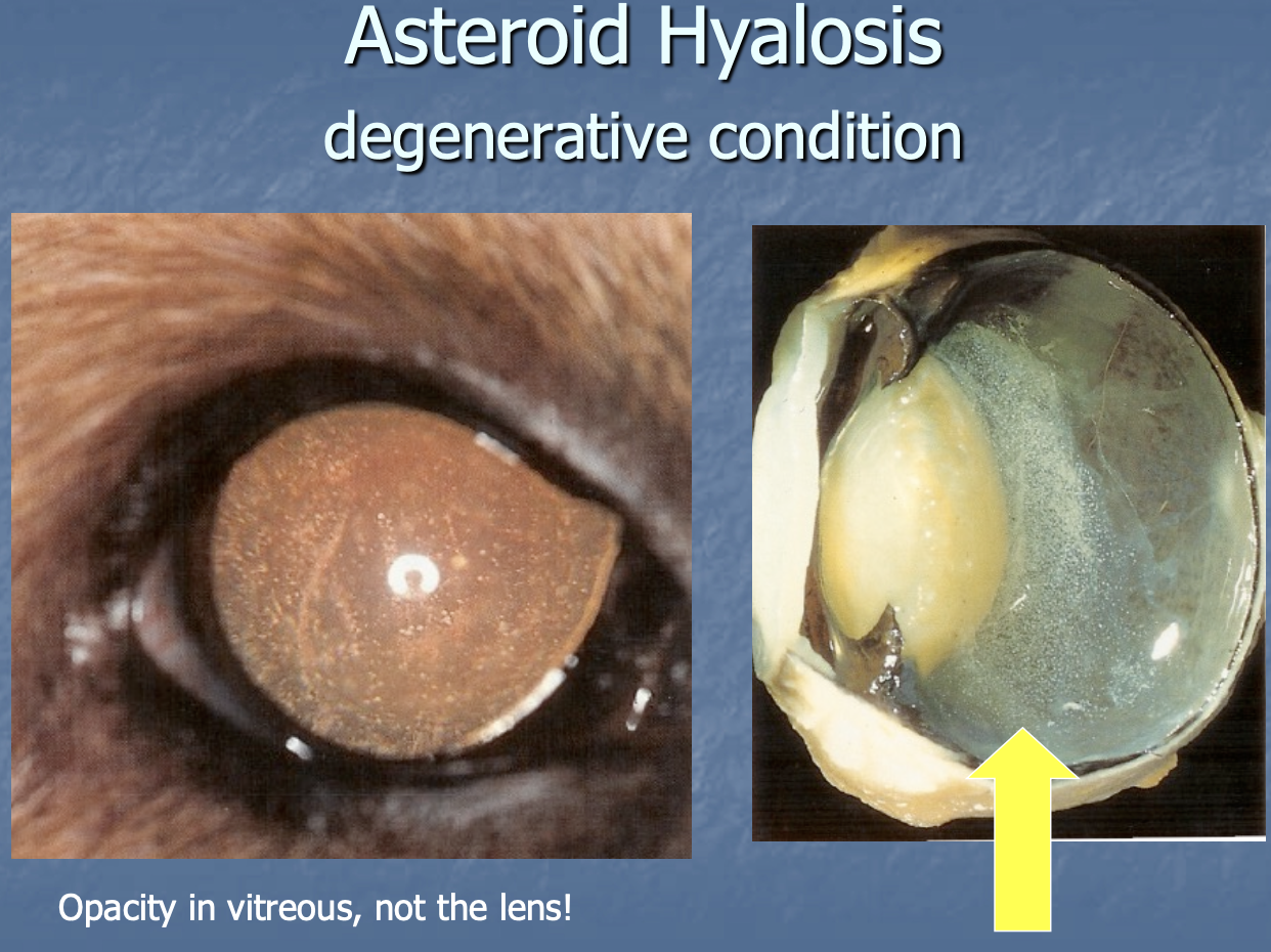 <p>degenerative condition where opacity is seen in the vitreous due to calcium phospholipid fixed in vitreous.</p>