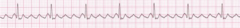 <p>abnormal p-waves that produce a saw-tooth appearance</p>