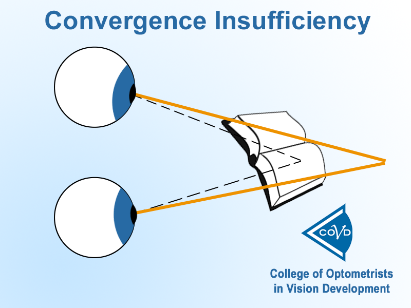 <p><strong>Changes in tension in the eye muscles </strong>that occur when the two eyes <strong>turn inwards to focus on objects that are close. The closer an object gets, the greater tension in the eye muscles. The further away an object gets, the less tension in the eye muscles</strong></p>