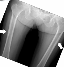 <p><span style="color: red;"><strong>Femoral Shaft BSI</strong></span></p>
