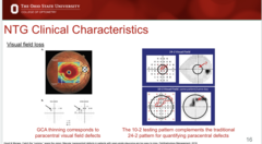 <p>The _____ testing pattern will complement the traditional 24-2 pattern for quantifying paracentral defects</p>