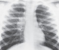 <p>This x-ray image indicates what pathology?</p>