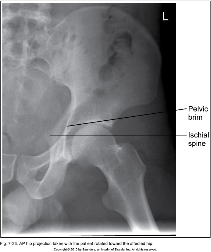 <p>AP hip</p>