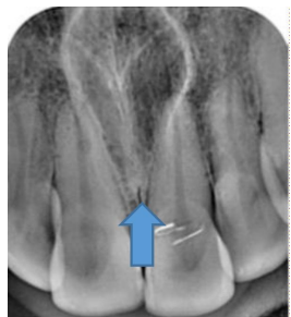 <p>A 23 year old presenting with a cystic swelling in midline in the anterior region of palate. Provide differential diagnosis</p>