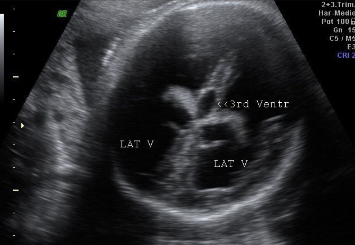 <p>What pathology is seen in this image?</p>